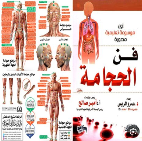 الحجامة النبوية