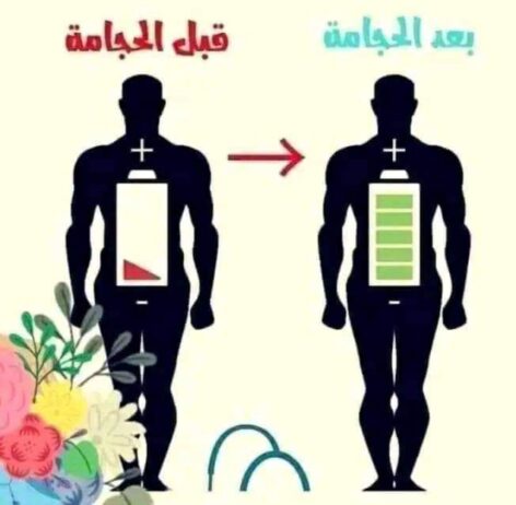 حجامة