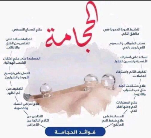 حجامة