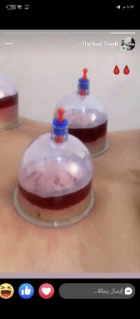حجامة