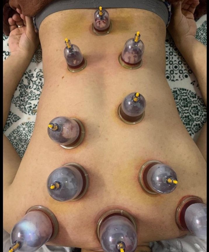 أبو عمر للحجامه