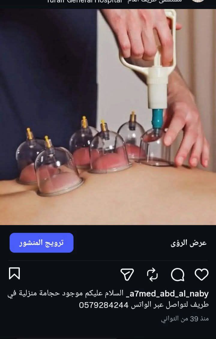 حجامة منزلية في طريف